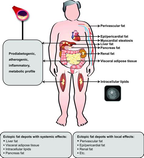 Body Fat Distribution And Risk Of Cardiovascular Disease Circulation