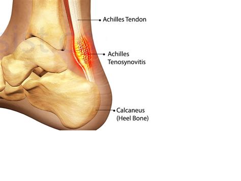 LESIONES DEL TENDÓN DE AQUILES Consulta Médica del Dolor