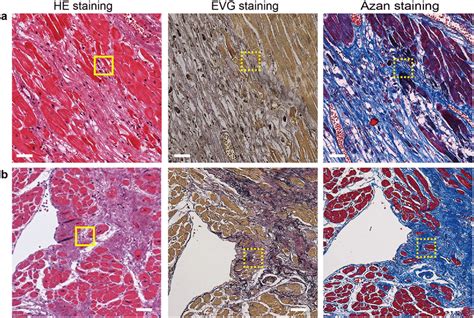 Staining Of Collagenous Tissue In The Infarcted Human Heart Left