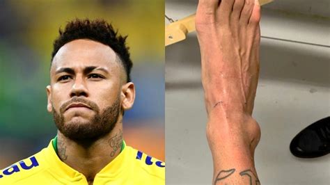 Así Quedó El Maltrecho Tobillo De Neymar