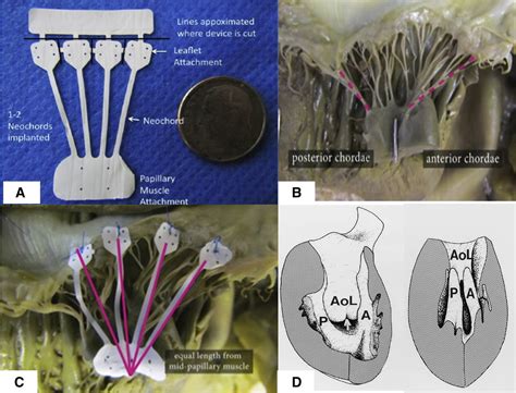 Performance And Healing Of An Expanded Polytetrafluoroethylene Multichordal Device At 6 Months