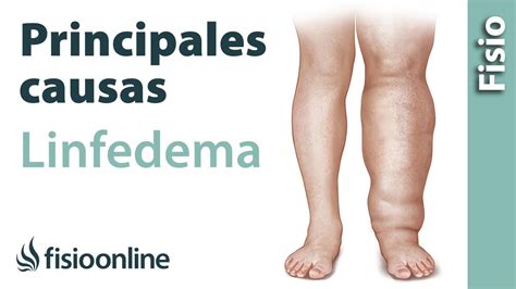 Tipos De Linfedema Y Principales Causas Youtube