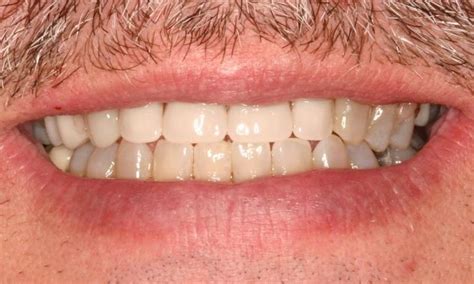 Full Partial Dentures Winter Haven Fl Smile Gallery