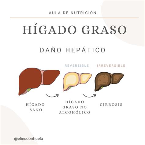 Tienes El H Gado Graso As Debes Adaptar La Alimentaci N