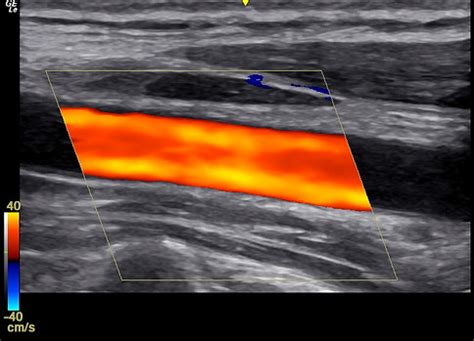 Carotid | Vascular Ultrasound Australia | Vascular Ultrasound Scans