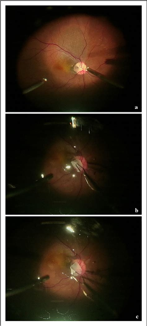 Management Of Unresolved Optic Disc Pit Maculopathy With Human Amniotic Membrane Patch Implant