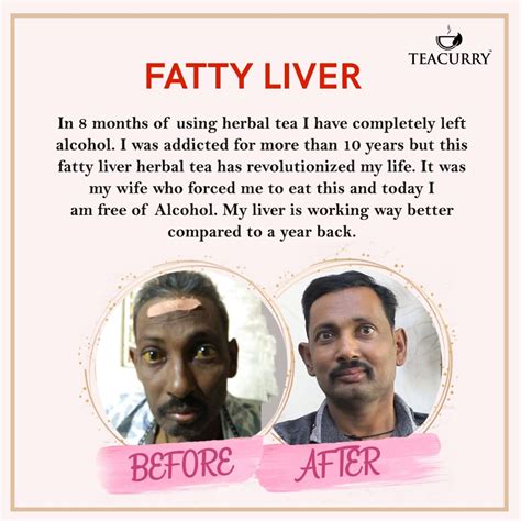 Teacurry Fatty Liver Tea Month Pack Tea Bags Helps With