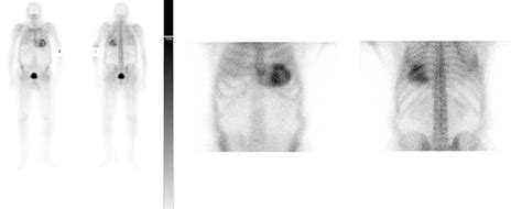 Scintigraphy With 99m Technetium Labeled Download Scientific Diagram