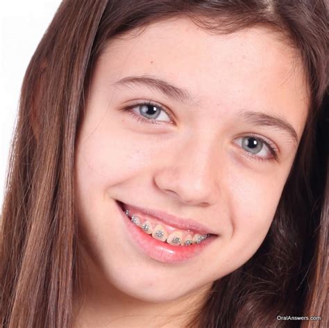 60 Photos Of Teenagers With Braces Robweigners Blog