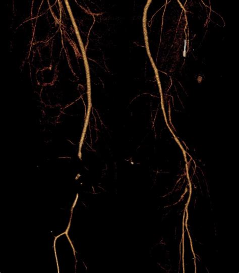 Acute Femoropopliteal Bypass Graft Occlusion After Knee Mani Jaaos