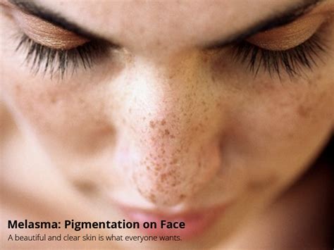 Melasma Pigmentation On Face Skinology