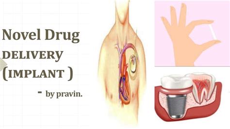 Implants As An Novel Drug Delivery Ppt