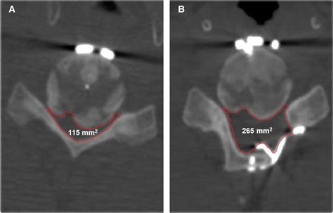 Frontiers Osteophyte Formation Causes Neurological Symptoms After Anterior Cervical Discectomy