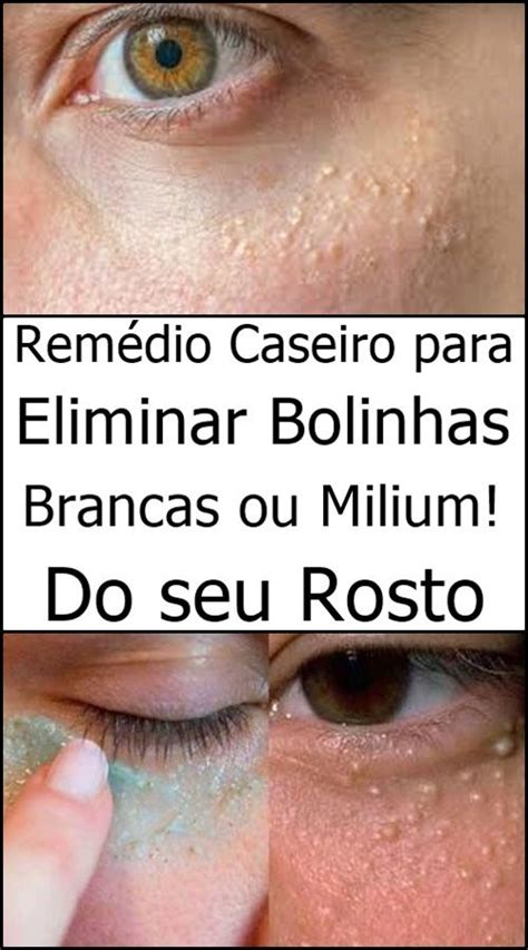 Remédio Caseiro para Eliminar Bolinhas Brancas ou Milium Remédios