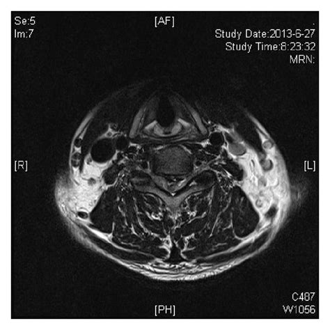 T2 Weighted Axial Magnetic Resonance Image The Spinal Cord Is Markedly