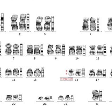 G Banded Karyotype Of A Male Patient Showing T 15 17 Q22 Q12 Download Scientific Diagram