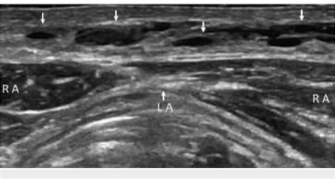 Figure 1 From Sonographic Detection Of Surgical Site Fluid Collections