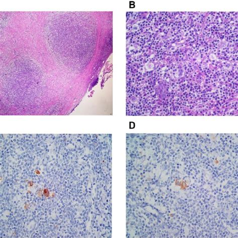 Nodular Sclerosis Classic Hodgkin Lymphoma A Nodular Growth Pattern