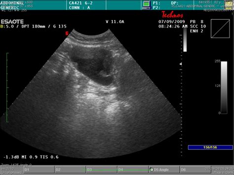 Mucocele Of The Appendix Eurorad