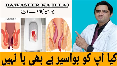 Bawaseer Ka Ilaj How To Get Rid Of Piles Hemorrhoids Causes Symptoms Treatment Bawasir Men