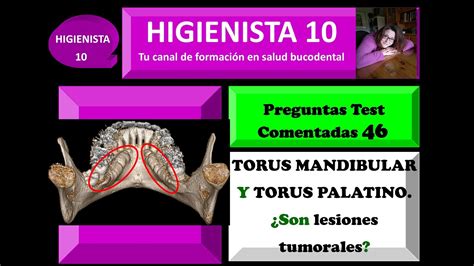 Torus Mandibular Y Torus Palatino Son Lesiones Tumorales Preguntas