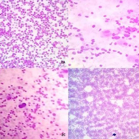 Reactive lymphadenitis showing polymorphous population of lymphoid ...