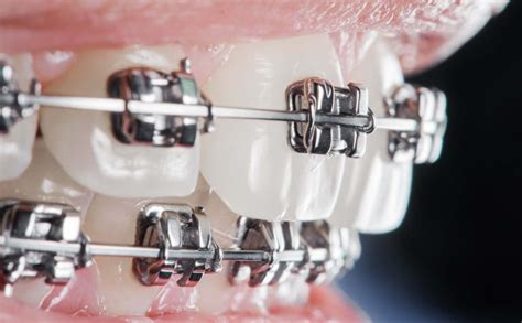 Orthodontic Treatment Wright Orthodontics