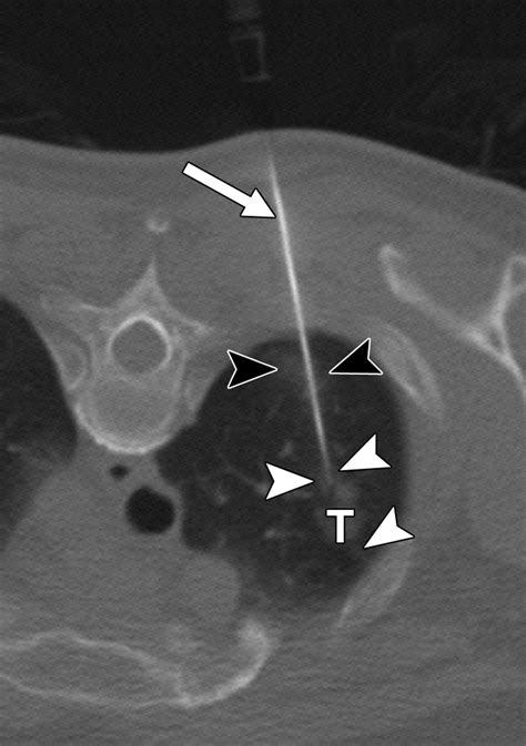 Ct Guided Core Biopsy Of Lung Lesions A Primer Ajr