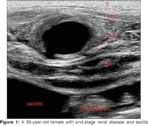 Figure From Deep Circumflex Iliac Artery Pseudoaneurysm As A