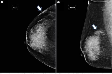 Figure From A Case Of Sparganosis That Mimicked Recurrence Of