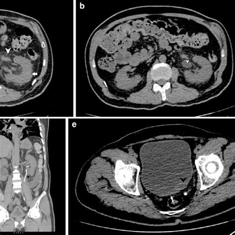 NCCT PNS (coronal section) showing bony dehiscence (arrowhead ...