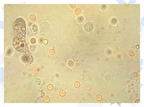 Sangre Oculta En Heces Y Pmn Ppt