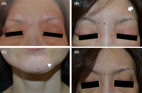 Angioedema‐like Eyelid Edema Following The Second Nvx‐cov2373 Covid‐19