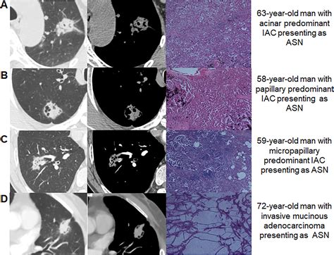 Evaluation Of Prognosis In Patients With Lung Adenocarcinoma With Atypical Solid Nodules On Thin