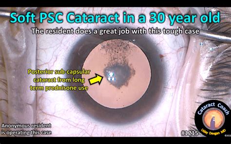 1215 Soft Psc Cataract In A 30 Year Old Cataract Coach™