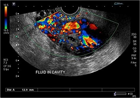 Arteriovenous Malformation Of The Uterus Dodia And George 2015