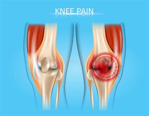 Knie Schmerz Und Arthritis Behandlungs Vektor Diagramm Vektor Abbildung