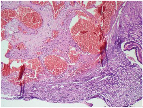 Microphotograph Showing A Well Circumscribed Tumor Composed Of