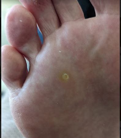 Corn Or Wart On My Foot Online Emergencydentistry