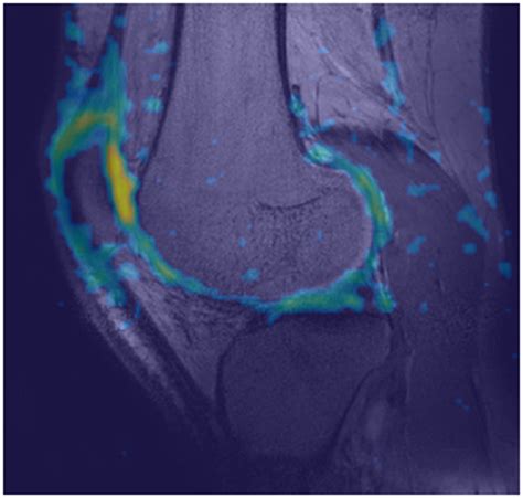 Uncompromised Mri Of Knee Cartilage While Incorporating Sensitive