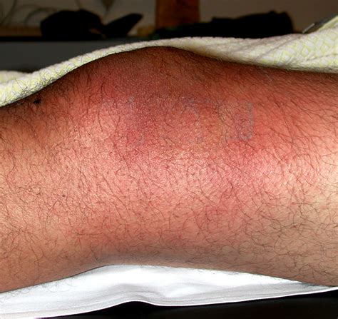 Collection 93 Images Pictures Of Cellulitis On Legs Updated