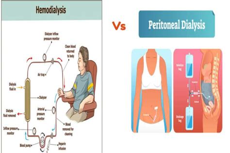 Peritoneal Dialysis Vs Hemodialysis Easy To Understand Article