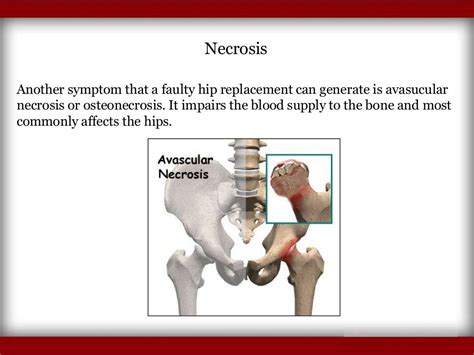 Symptoms of Hip Replacement Implant Recall