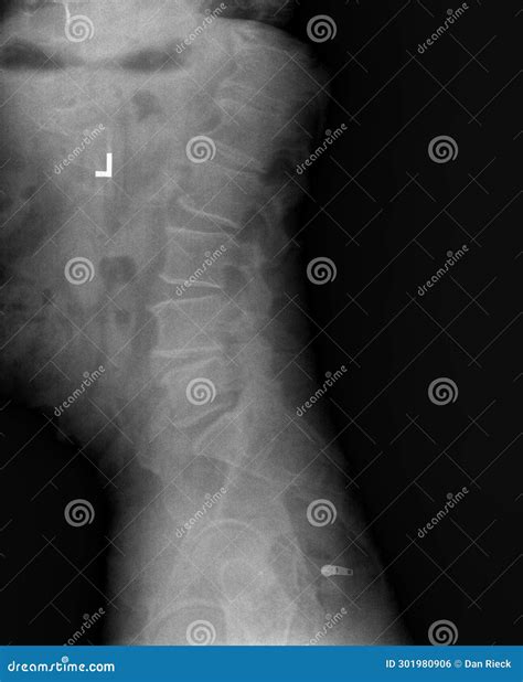 Film Xray Or Radiograph Of Lumbar Low Back Vertebrae Showing Facet