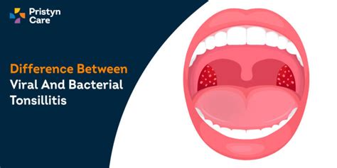 Difference Between Viral And Bacterial Tonsillitis