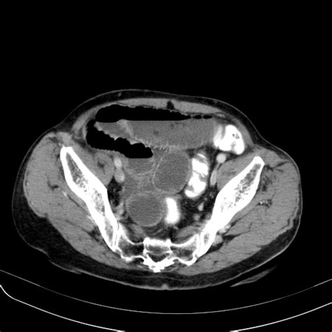 File Small Bowel Volvulus Causing Small Bowel Obstruction Mimicking