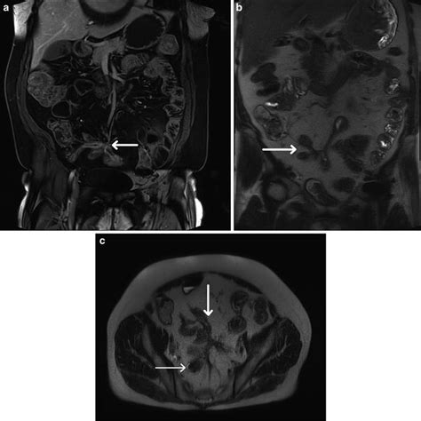 Magnetic Resonance Enterography Abdominal Key