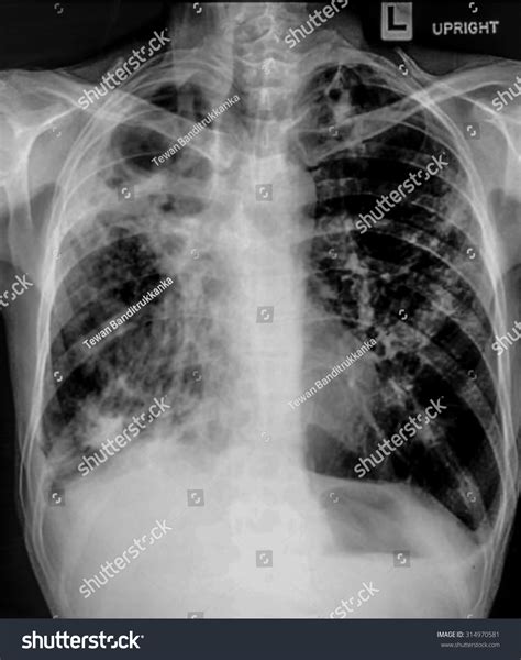 Chest X Ray Showing Infiltrate Lung Pneumonia Stock Photo 314970581