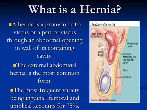 Basics Of Inguinal Hernias Ppt