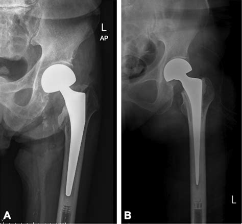 Examples Of Cemented Femoral Stem Design A Shape Closed Stem As Download Scientific Diagram